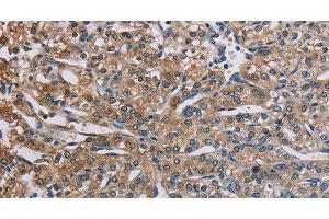 Immunohistochemistry of paraffin-embedded Human prostate cancer using PLXND1 Polyclonal Antibody at dilution of 1:40