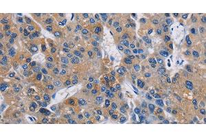 Immunohistochemistry of paraffin-embedded Human liver cancer using GPM6A Polyclonal Antibody at dilution of 1:40