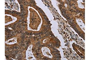The image on the left is immunohistochemistry of paraffin-embedded Human colon cancer tissue using ABIN7191460(MIG7 Antibody) at dilution 1/35, on the right is treated with synthetic peptide. (TOX4 antibody)