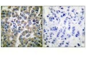 Immunohistochemical analysis of paraffin-embedded human breast carcinoma tissue using HSP10 antibody. (HSPE1 antibody)