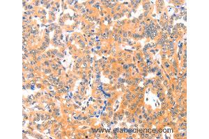 Immunohistochemistry of Human cervical cancer using THBS1 Polyclonal Antibody at dilution of 1:60 (Thrombospondin 1 antibody)