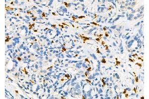 ABIN6258709 and ABIN6275128 at 1/100 staining Human pancreatic cancer and adjacent non-tumor tissue by IHC-P. (FOXD4 antibody  (Internal Region))