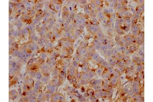 IHC image of ABIN7127430 diluted at 1:100 and staining in paraffin-embedded human breast cancer performed on a Leica BondTM system. (Recombinant Clusterin antibody)