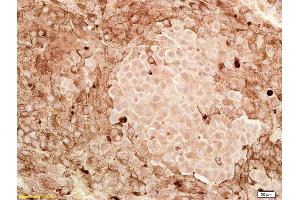 Formalin-fixed and paraffin embedded human melanoma labeled with Anti-CITED1/ABCC1 Polyclonal Antibody, Unconjugated (ABIN682543) at 1:200, followed by conjugation to the secondary antibody and DAB staining (CITED1 antibody  (AA 121-193))