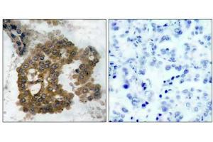 Immunohistochemical analysis of paraffin-embedded human lung carcinoma tissue using Akt2 (phospho- Ser474) antibody (E011124). (AKT2 antibody  (pSer474))