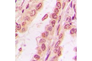 Immunohistochemical analysis of PPHLN1 staining in human breast cancer formalin fixed paraffin embedded tissue section.