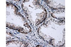 Immunohistochemical staining of paraffin-embedded Adenocarcinoma of breast tissue using anti-PTPRE mouse monoclonal antibody. (PTPRE antibody)