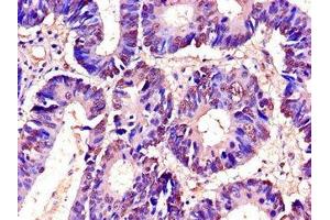 Immunohistochemistry of paraffin-embedded human colon cancer using ABIN7173542 at dilution of 1:100 (C22orf28 antibody  (AA 52-229))