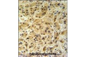 GNS Antibody (Center ) (ABIN390494 and ABIN2840853) IHC analysis in formalin fixed and paraffin embedded human hepatocarcinoma followed by peroxidase conjugation of the secondary antibody and DAB staining. (GNS antibody  (AA 174-203))