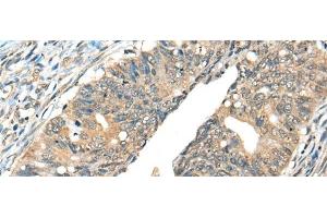 Immunohistochemistry of paraffin-embedded Human colorectal cancer tissue using AIFM2 Polyclonal Antibody at dilution of 1:40(x200) (AIFM2 antibody)