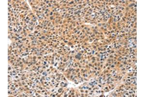 The image on the left is immunohistochemistry of paraffin-embedded Human lung cancer tissue using ABIN7129182(DDX4 Antibody) at dilution 1/20, on the right is treated with fusion protein. (DDX4 antibody)