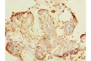 Immunohistochemistry of paraffin-embedded human breast cancer using ABIN7161600 at dilution of 1:100 (NIF3L1 antibody  (AA 1-377))