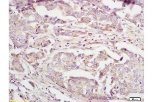 Formalin-fixed and paraffin embedded human breast carcinoma labeled with Anti-IL-22BP Polyclonal Antibody, Unconjugated (ABIN748193) at 1:200 followed by conjugation to the secondary antibody and DAB staining. (IL22RA2 antibody  (AA 165-263))