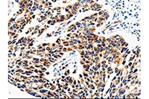 The image is immunohistochemistry of paraffin-embedded Human lung cancer tissue using ABIN7129010(COX16 Antibody) at dilution 1/50. (COX16 antibody)