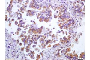 Formalin-fixed and paraffin embedded human lung carcinoma labeled with Anti-5 lipoxygenase/ALOX5 Polyclonal Antibody, Unconjugated (ABIN669651) at 1:200 followed by conjugation to the secondary antibody and DAB staining (ALOX5 antibody  (AA 601-674))