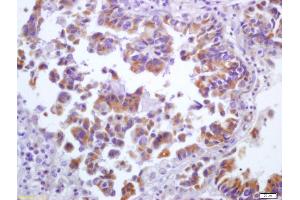 Formalin-fixed and paraffin embedded human lung carcinoma labeled with Anti-5 lipoxygenase/ALOX5 Polyclonal Antibody, Unconjugated (ABIN669651) at 1:200 followed by conjugation to the secondary antibody and DAB staining