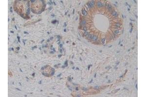 Detection of ACTN4 in Human Bile duct cancer Tissue using Polyclonal Antibody to Actinin Alpha 4 (ACTN4) (alpha Actinin 4 antibody  (AA 1-269))