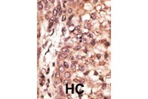 Formalin-fixed and paraffin-embedded human cancer tissue reacted with the primary antibody, which was peroxidase-conjugated to the secondary antibody, followed by DAB staining. (CREB3L1 antibody  (C-Term))