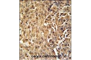 ZC3HAV1 Antibody (C-term) (ABIN651882 and ABIN2840438) immunohistochemistry analysis in formalin fixed and paraffin embedded human cervix carcinoma followed by peroxidase conjugation of the secondary antibody and DAB staining. (ZC3HAV1 antibody  (C-Term))