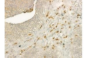 ABIN6259101 and ABIN6275839 at 1/100 staining human cervical carcinoma by IHC-P. (MATK antibody  (Internal Region))