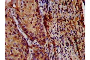 IHC image of ABIN7158410 diluted at 1:200 and staining in paraffin-embedded human lung cancer performed on a Leica BondTM system. (LIPH antibody  (AA 175-325))