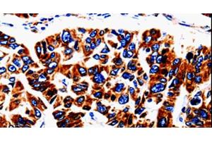 Immunohistochemistry of paraffin-embedded Human lung cancer tissue using UTS2 Polyclonal Antibody at dilution 1:50 (Urotensin 2 antibody)