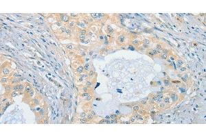 Immunohistochemistry of paraffin-embedded Human cervical cancer using CHRNA2 Polyclonal Antibody at dilution of 1:40 (CHRNA2 antibody)