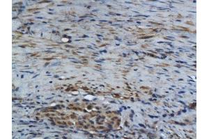 Formalin-fixed and paraffin embedded human colon carcinoma labeled with Rabbit Anti GM-CSF Polyclonal Antibody, Unconjugated  at 1:200 followed by conjugation to the secondary antibody and DAB staining (GM-CSF antibody  (AA 65-144))