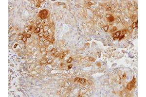 IHC-P Image Immunohistochemical analysis of paraffin-embedded OVCA xenograft, using Glycerol kinase 2, antibody at 1:100 dilution. (GK2 antibody)