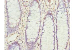Immunohistochemistry of paraffin-embedded human colon cancer using ABIN7168204 at dilution of 1:100 (RPS6KL1 antibody  (AA 1-130))