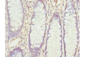 Immunohistochemistry of paraffin-embedded human colon cancer using ABIN7168204 at dilution of 1:100