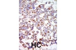 Formalin-fixed and paraffin-embedded human cancer tissue reacted with the primary antibody, which was peroxidase-conjugated to the secondary antibody, followed by AEC staining. (TR4 antibody  (C-Term))
