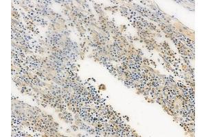 ABIN6255566 and ABIN6274063 at 1/100 staining human colon carcinoma by IHC-P.