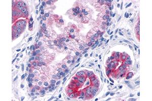 Anti-TNIK antibody IHC of human Prostate, Carcinoma. (TNIK antibody  (Internal Region))