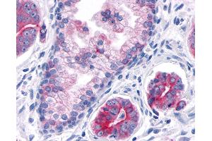 Anti-TNIK antibody IHC of human Prostate, Carcinoma.