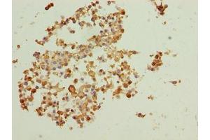 Immunohistochemistry of paraffin-embedded human breast cancer using ABIN7145831 at dilution of 1:100 (BTBD2 antibody  (AA 321-525))