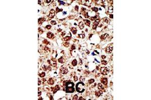 Formalin-fixed and paraffin-embedded human cancer tissue reacted with FDFT1 polyclonal antibody  , which was peroxidase-conjugated to the secondary antibody, followed by DAB staining . (FDFT1 antibody  (Internal Region))