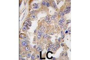 Formalin-fixed and paraffin-embedded human lung carcinoma tissue reacted with AGR2 antibody (Center), which was peroxidase-conjugated to the secondary antibody, followed by DAB staining. (AGR2 antibody  (AA 95-124))