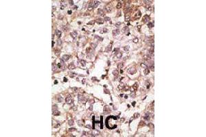 Formalin-fixed and paraffin-embedded human hepatocellular carcinoma tissue reacted with SIGLEC7 polyclonal antibody  , which was peroxidase-conjugated to the secondary antibody, followed by AEC staining. (SIGLEC7 antibody  (N-Term))