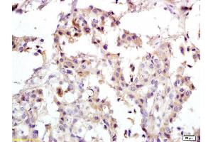 Formalin-fixed and paraffin embedded human breast carcinoma labeled with Anti-PRKCDBP Polyclonal Antibody, Unconjugated (ABIN762206) at 1:200 followed by conjugation to the secondary antibody and DAB staining (PRKCDBP antibody  (AA 151-250))