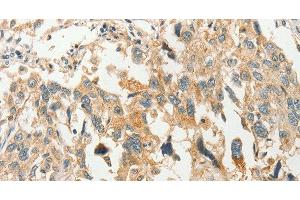 Immunohistochemistry of paraffin-embedded Human esophagus cancer tissue using SLC11A2 Polyclonal Antibody at dilution 1:50 (SLC11A2 antibody)
