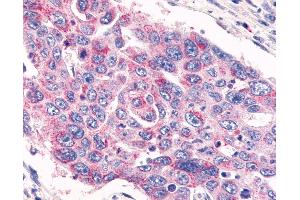Anti-GPR26 antibody IHC of human Colon, Carcinoma. (GPR26 antibody  (Cytoplasmic Domain))