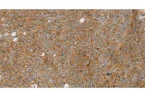 Immunohistochemistry of paraffin-embedded Human ovarian cancer using STX16 Polyclonal Antibody at dilution of 1:30 (Syntaxin 16 antibody)