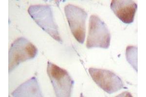 Immunohistochemistry analyzes of Crystallin-αB antibody in paraffin-embedded human breast carcinoma tissue. (CRYAB antibody)