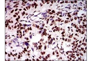 Immunohistochemical analysis of paraffin-embedded human esophageal cancer tissues using KIAA1967 mouse mAb with DAB staining. (CCAR2 antibody)