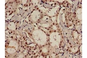 Immunohistochemistry analysis of human breast cancer using ABIN7159096 at dilution of 1:100 (MDC1 antibody  (AA 1892-2082))
