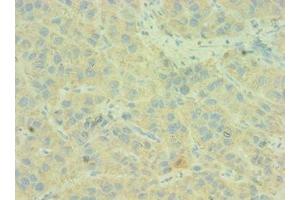 Immunohistochemistry of paraffin-embedded human liver cancer using ABIN7146168 at dilution of 1:100 (C4BPB antibody  (AA 18-252))