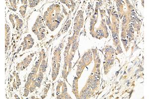 ABIN6265478 and ABIN6279868 at 1/100 staining Human pancreatic cancer by IHC-P. (TBC1D2 antibody  (N-Term))