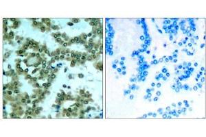 Immunohistochemical analysis of paraffin-embedded human lung carcinoma tissue, using PKCθ (phospho- Ser676) antibody (E011297). (PKC theta antibody  (pSer676))