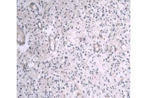 DAB staining on IHC-P; Samples: Human Glioma Tissue (APOA1 antibody  (AA 122-267))